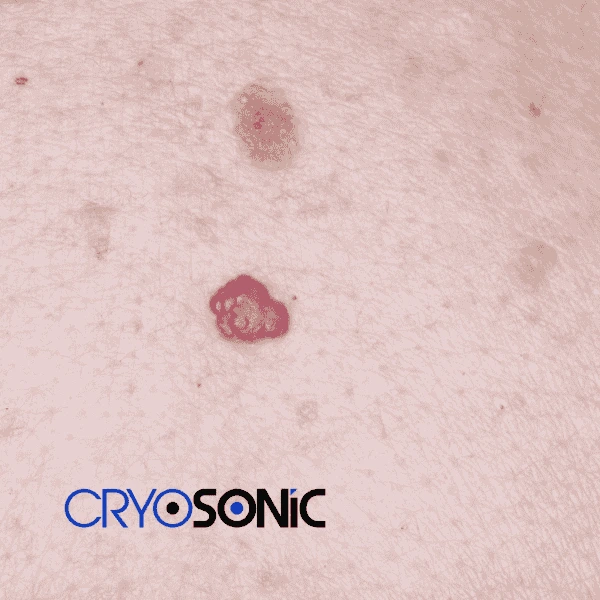 Looking for pain free cherry angioma removal treatment Crewe? Call our team today! Crewe