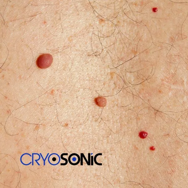 get cherry angioma removal treatment today! Crewe