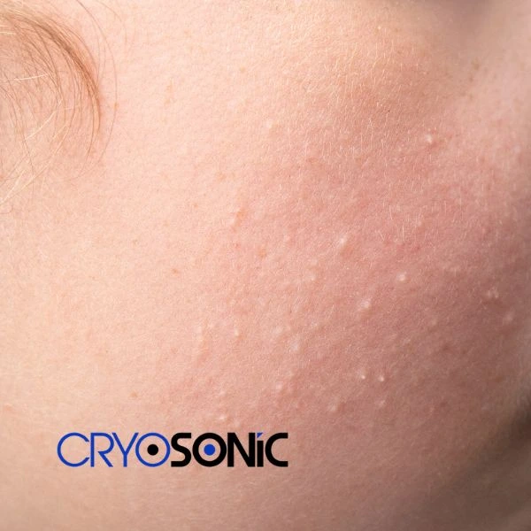Are you looking for milia removal treatment? Contact our team today Crewe
