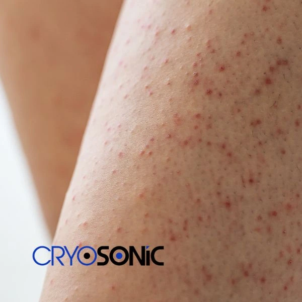 Looking for Seborrhoeic Keratosis removal Crewe treatment? Call our consultants today in Crewe