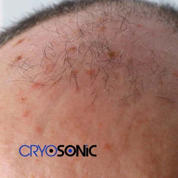 Access Seborrhoeic Keratosis removal from the comfort of your own home! Call us today in Crewe