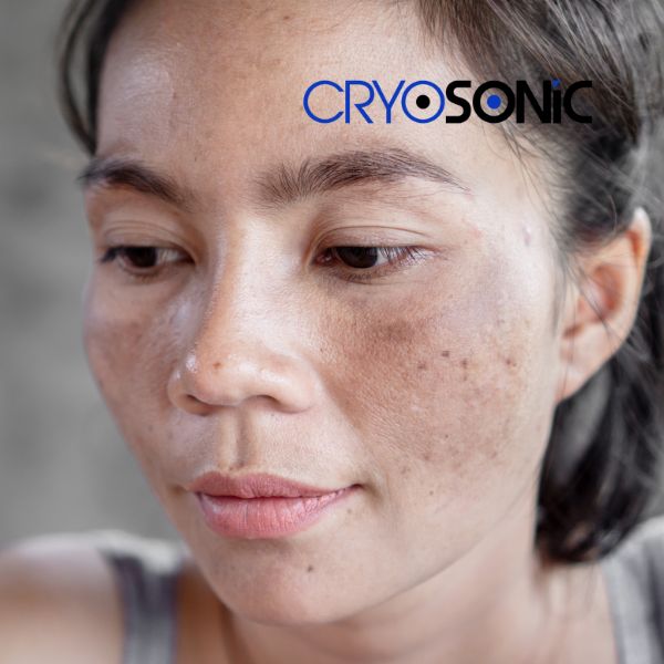 Ready to start age spots removal? Contact our team today in Crewe