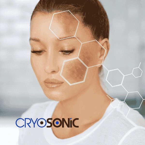 Are you looking for age spot removal treatment? Contact Cryosonic today in Crewe