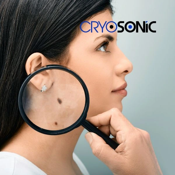 Do you want to learn more about benign moles removal treatment? Call our team today Crewe
