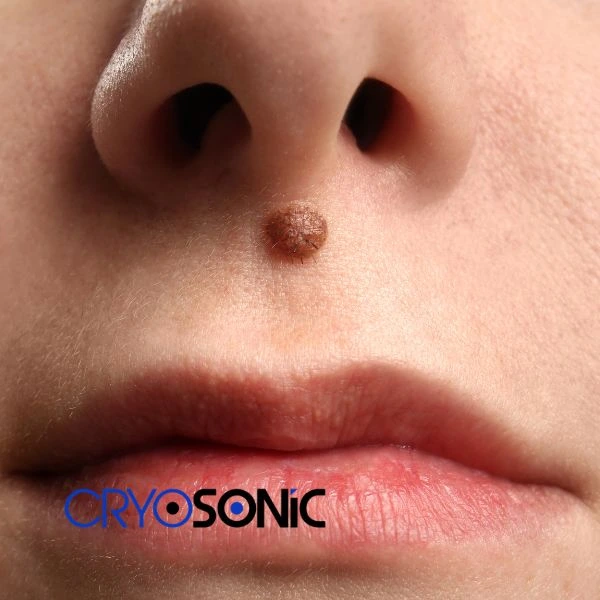 Start your benign moles removal treatment today Crewe