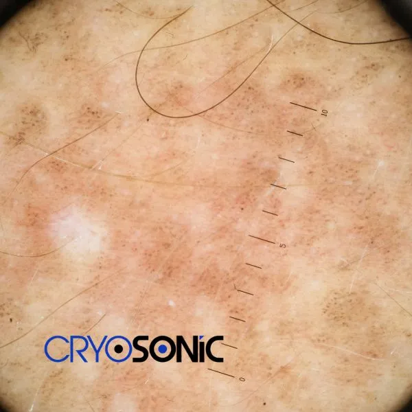 Speak to our team today about sun damaged skin treatment today in Crewe