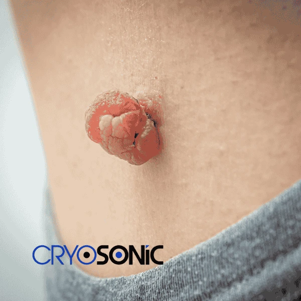Book your skin tags removal Crewe from comfort of your own home! Crewe