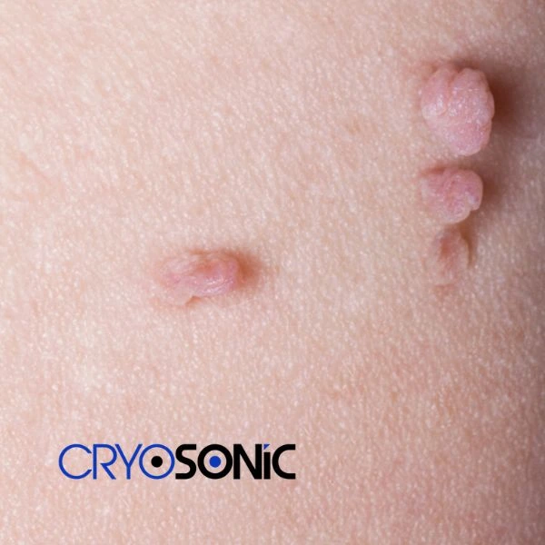 Are you looking for fast effect skin tag removal Crewe? Book in NOW! Crewe