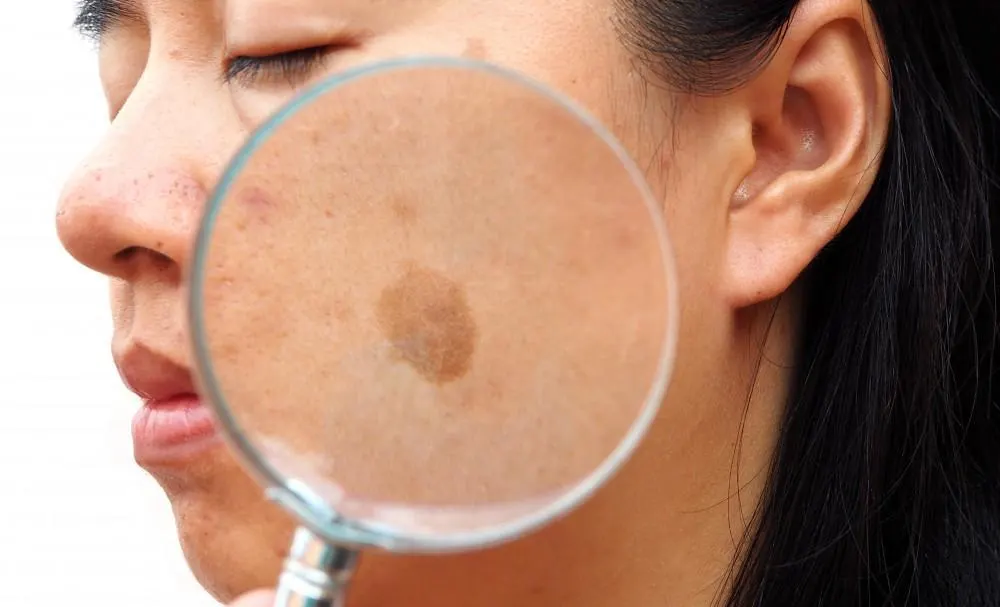 How Seborrheic Keratosis Crewe appears on the skin Crewe
