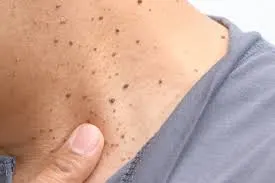 Seborrheic Keratosis: Understanding Skin Changes and CryoPen Treatment Options Crewe