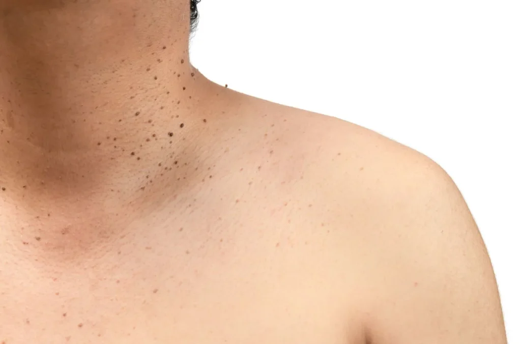 How to Maintain Healthy Skin After Treatment Crewe? Crewe