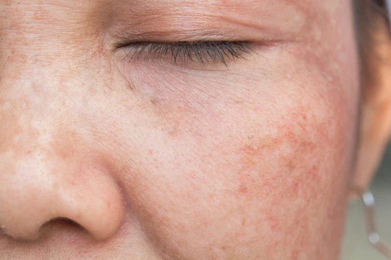 UV rays affecting skin cells, showing sun damage and the need for Cryosonic repair treatments Crewe. Crewe