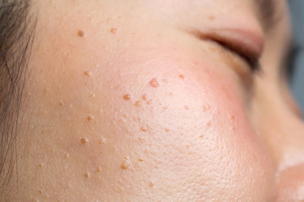 Why Choose CryoPen for Seborrheic Keratosis Crewe Crewe