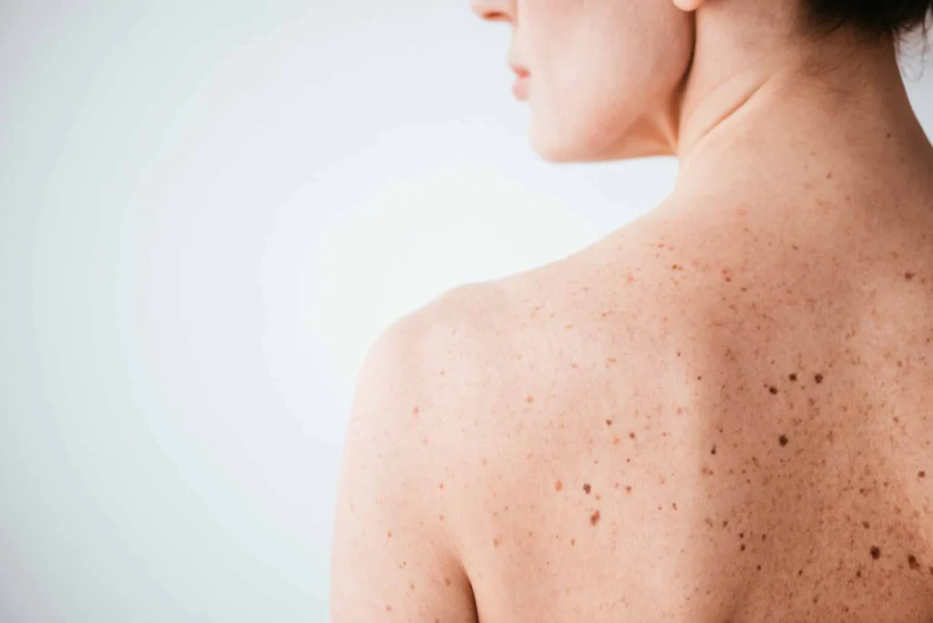 Sun Damage : Understanding UV Effects and Skin Repair Options Crewe